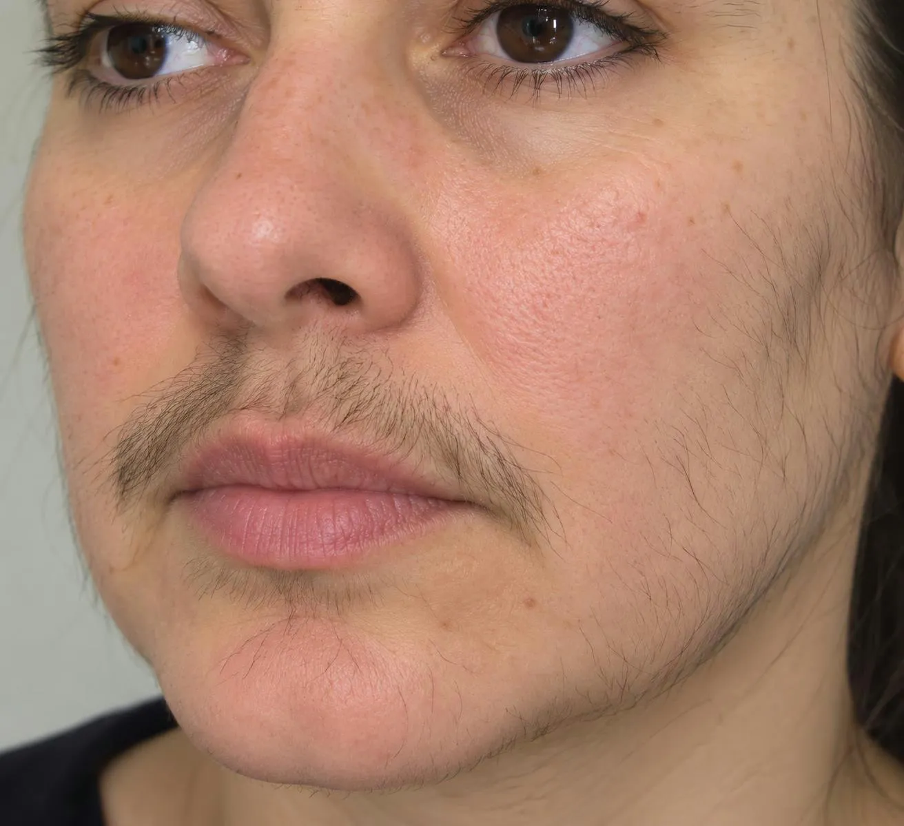 Unerwünschter Haarwuchs im Gesicht – Einsatzgebiet des Diodenlasers
