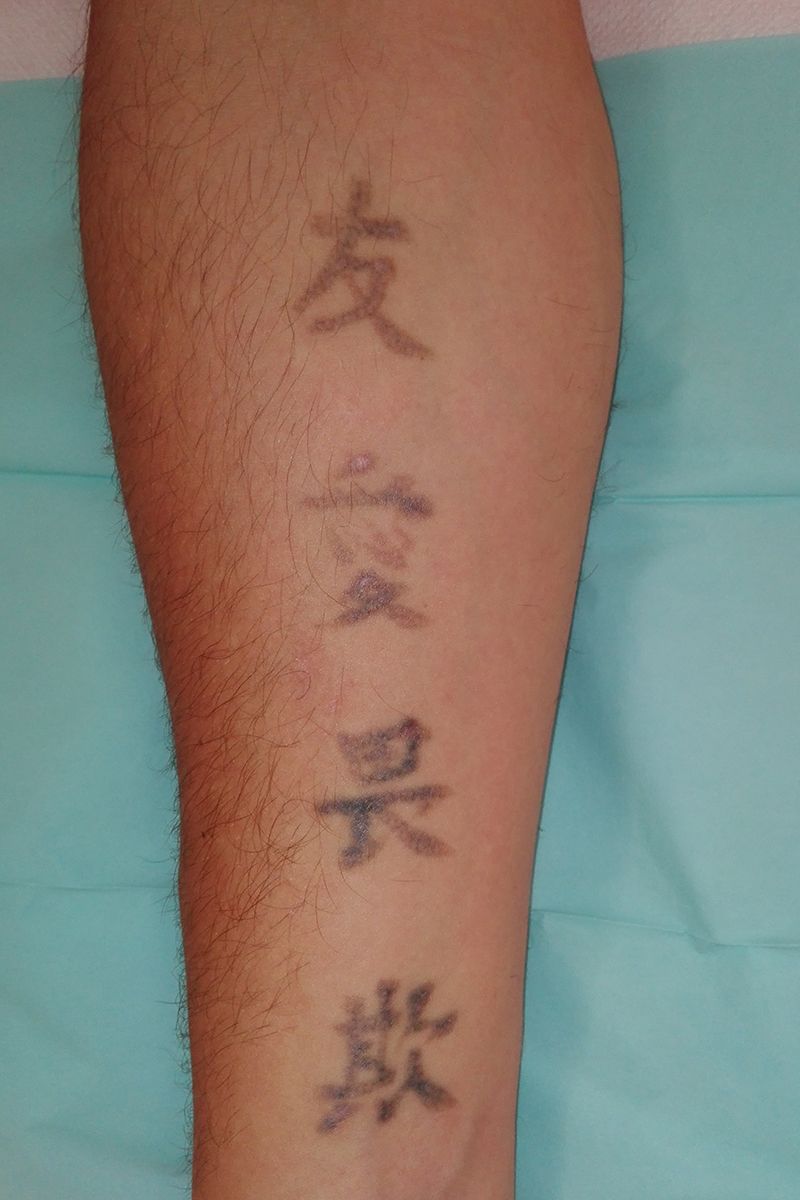3. Behandlung 5/17