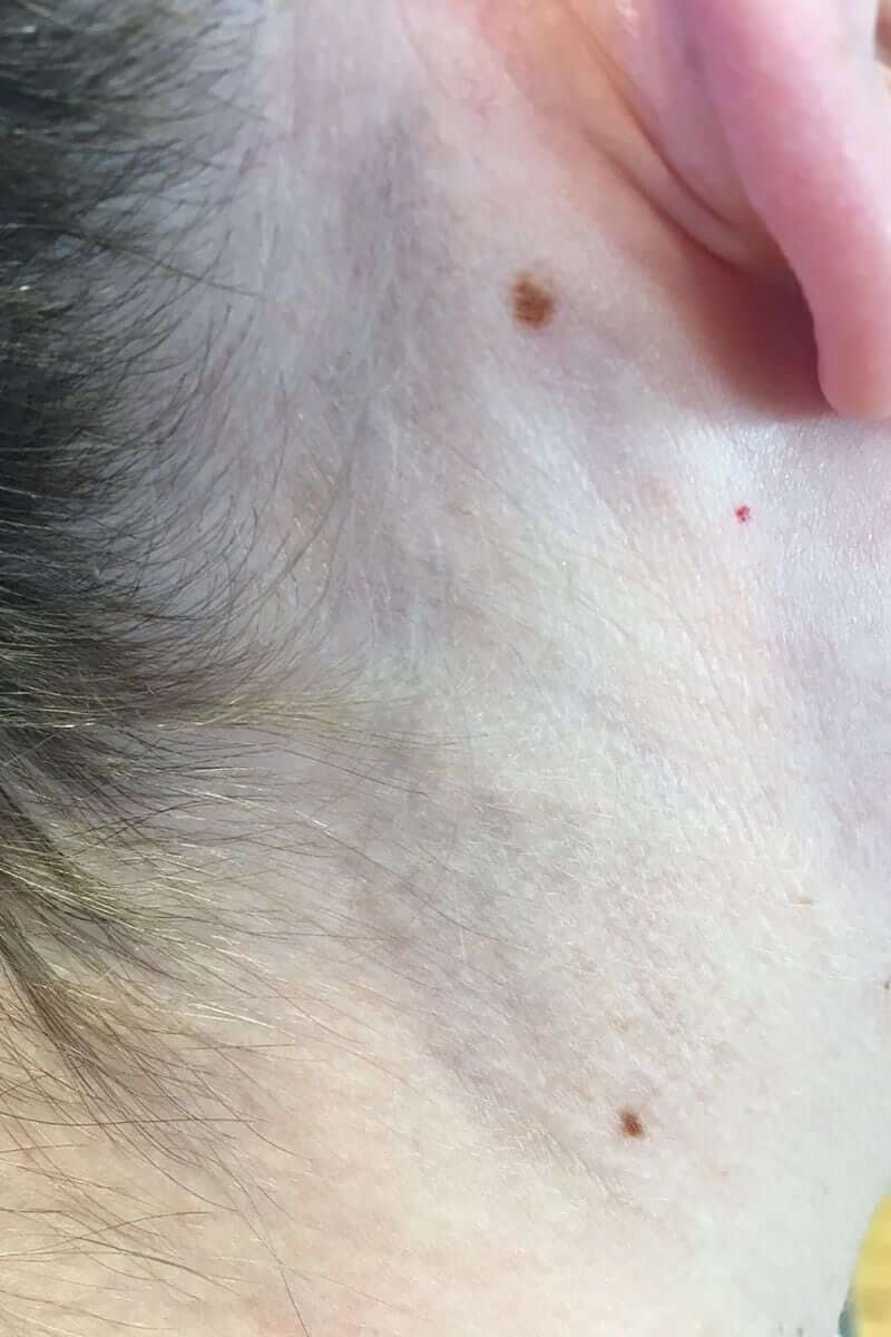 nach 6. Laser 10/17