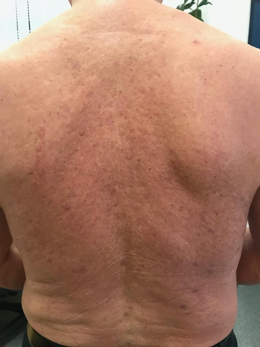 Kontrolle nach 6 Wochen