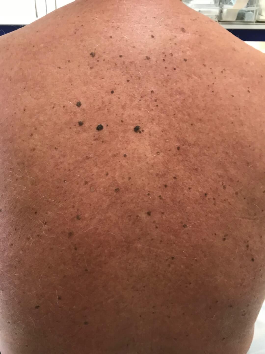 vor der Behandlung