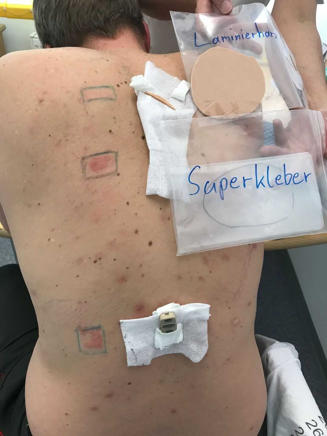 komplizierte-Allergieaustestung