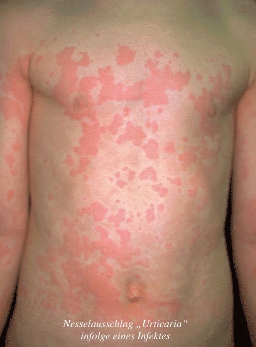 Urticaria im Rahmen eines Infektes